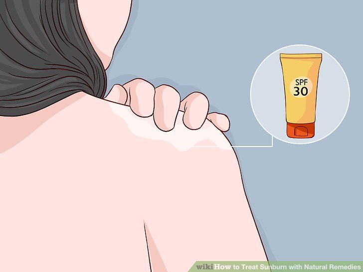 Treat Sunburn with Natural Remedies Step 7 Version 2.jpg